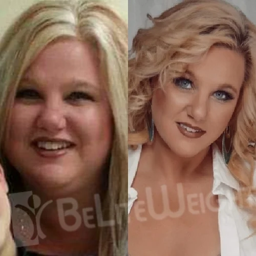 Bypass Revision before and after Stepenie B - 1 Year Update*